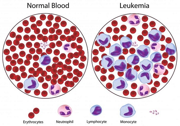 Faktor dan Penyebab Leukemia