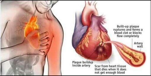 Pengertian Penyakit Kardiovaskuler